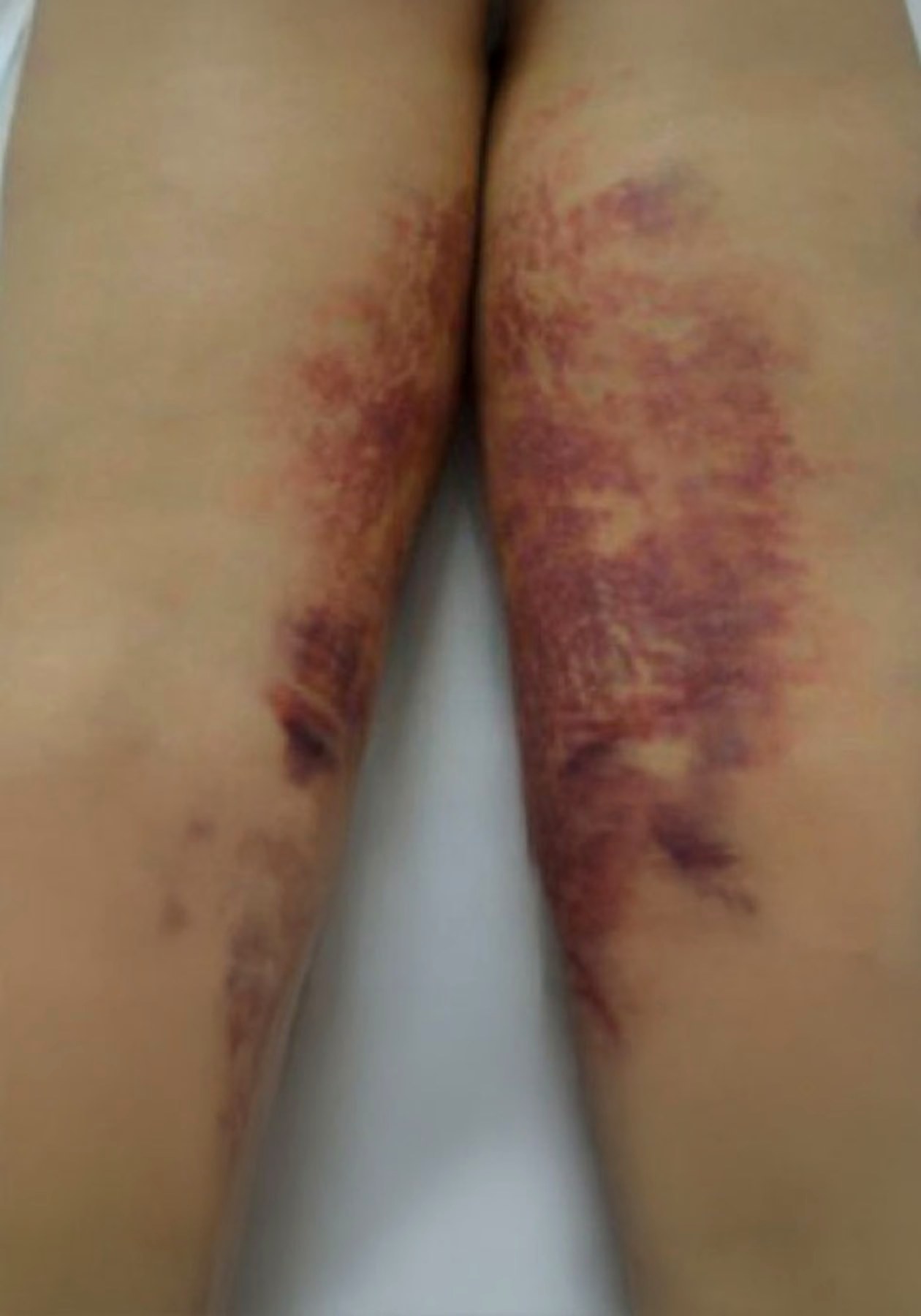 Antes tratamiento corporal caso 2