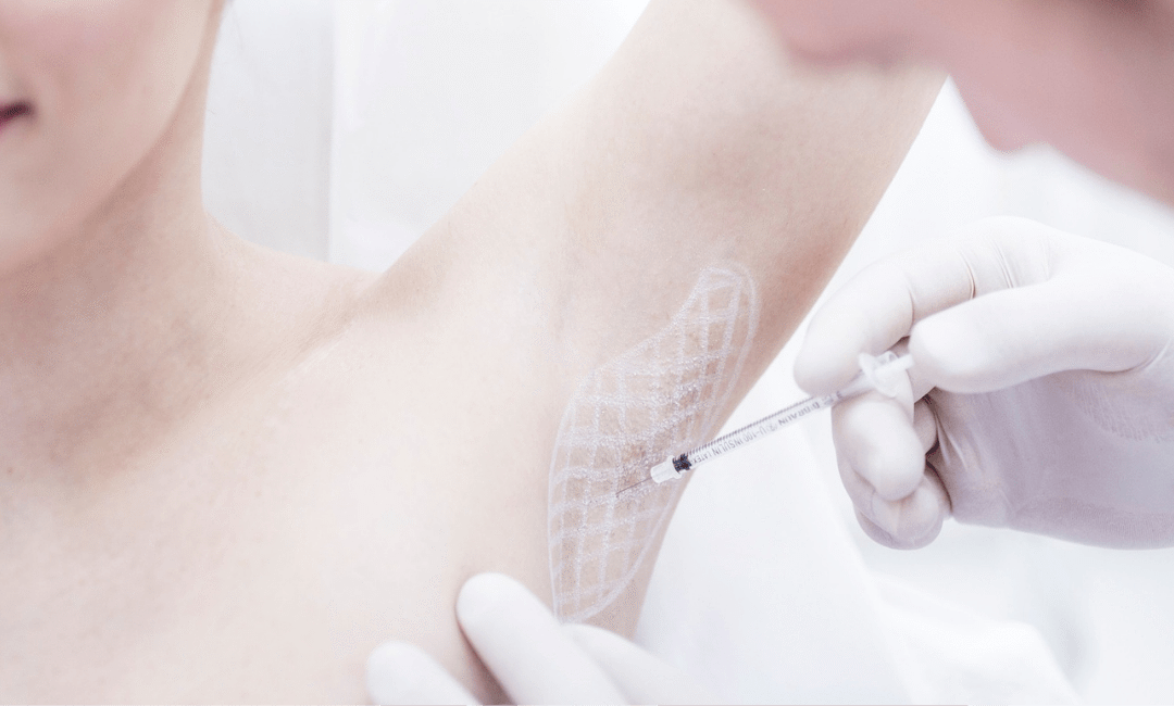 HIPERHIDROSIS AXILAR: ¿QUÉ SOLUCIÓN PROPONE LA MEDICINA ESTÉTICA?