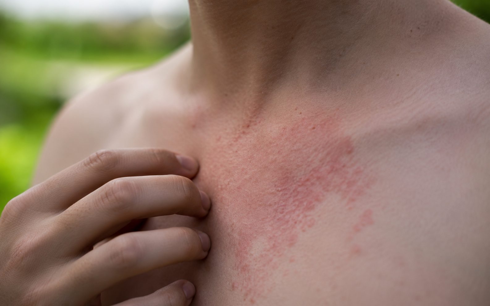 Irritación en cuello y escote compatible con alergia al sol