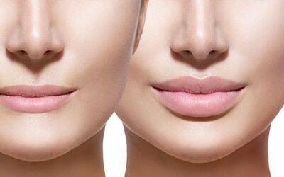 LAS 7 PRECAUCIONES A TENER EN CUENTA DESPUÉS DE PONERSE ÁCIDO HIALURÓNICO EN LOS LABIOS