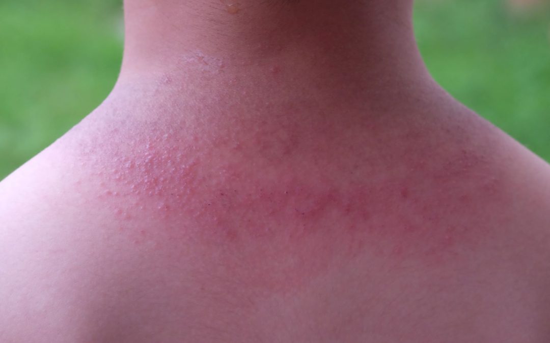 Hiperhidrosis y sarpullido por calor
