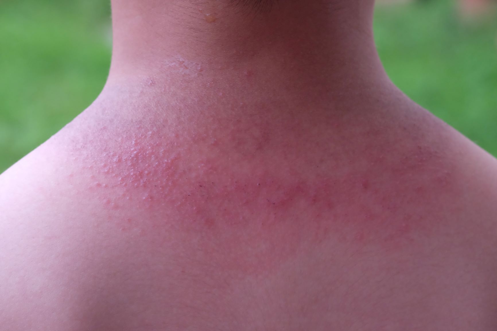 Sarpullido por calor relacionado con hiperhidrosis y sudoración excesiva